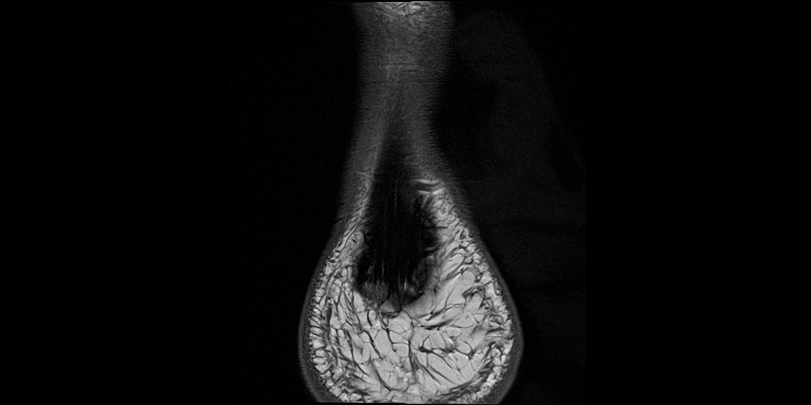 MRI Ankle coronal ligaments cross sectional anatomy 3T  radiology  image-img-00001-00032.webp